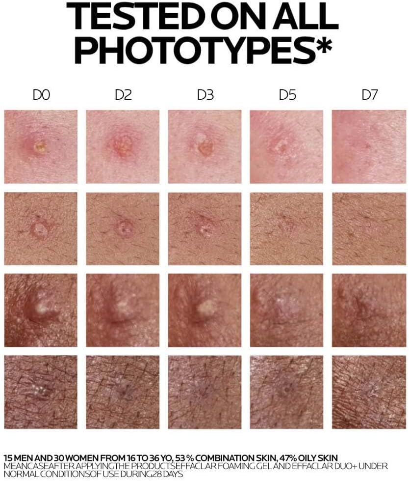 كريم علاج حب الشباب La Roche-Posay Effaclar Duo+M للبشرة الدهنية والحساسة والمعرضة لحب الشباب؛ يصحح الرؤوس السوداء والعيوب وعلامات ما بعد حب الشباب وعلاج البقع للعناية بالبشرة 40 مل - الصورة 8