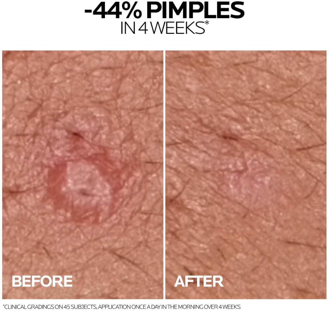 كريم علاج حب الشباب La Roche-Posay Effaclar Duo+M للبشرة الدهنية والحساسة والمعرضة لحب الشباب؛ يصحح الرؤوس السوداء والعيوب وعلامات ما بعد حب الشباب وعلاج البقع للعناية بالبشرة 40 مل - الصورة 5